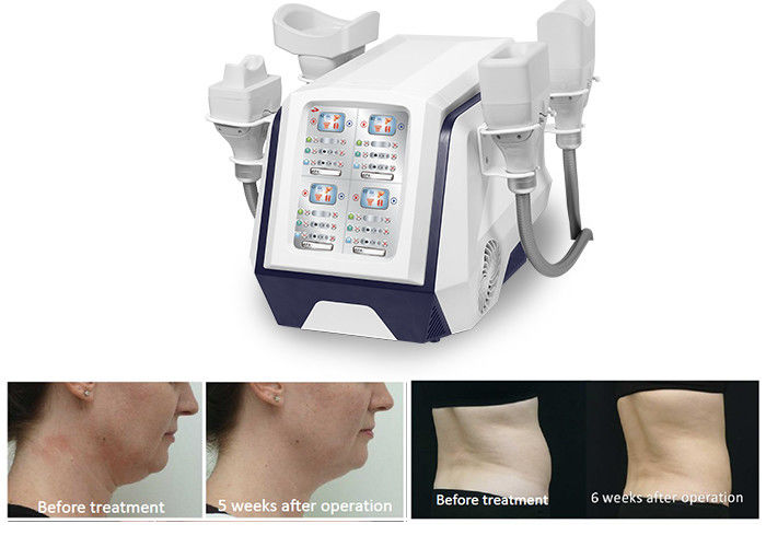 Тело Cryolipolysis портативной машинки 360 уменьшая машину 1000W для жирной горящей потери веса